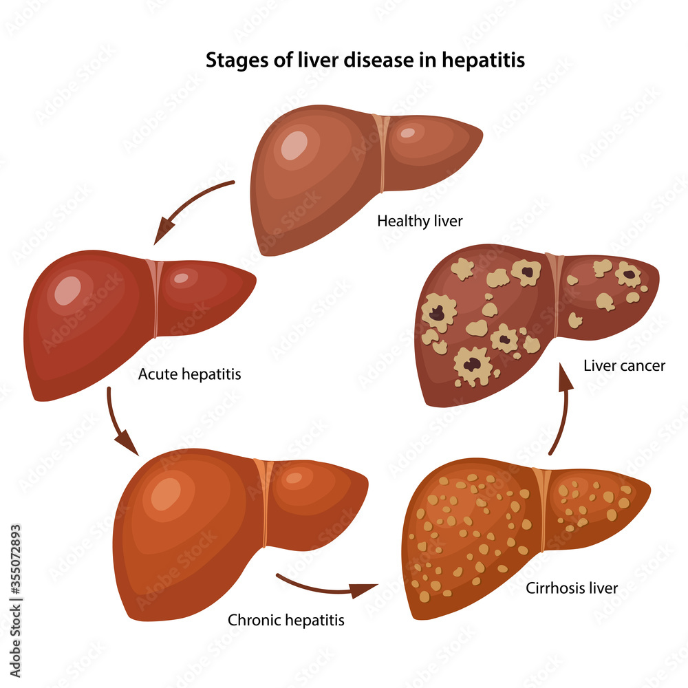 Hepatitis Adalah Penyakit Liver yang Perlu Diketahui Semua Orang