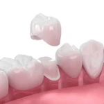 Crown Gigi